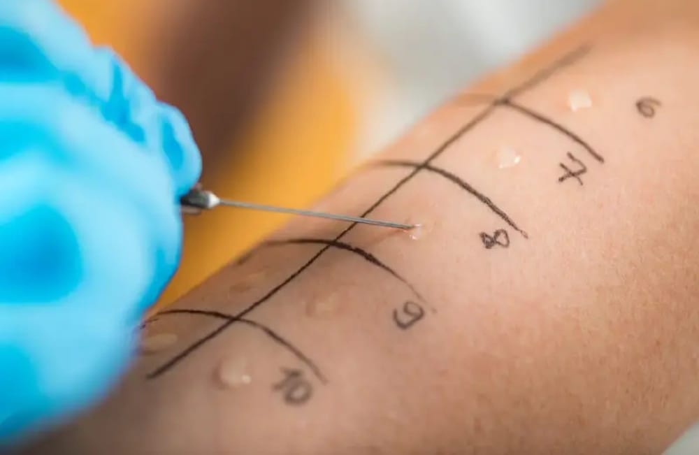 انواع تست آلرژی کودکان