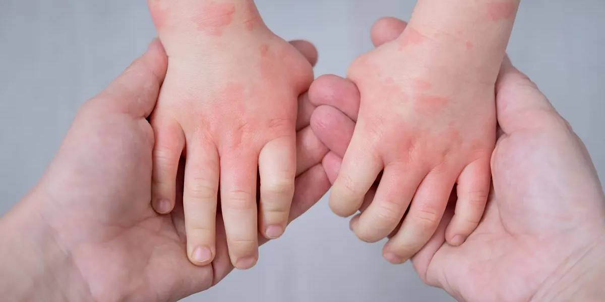 تشخیص مشکلات پوستی شایع در کودکان