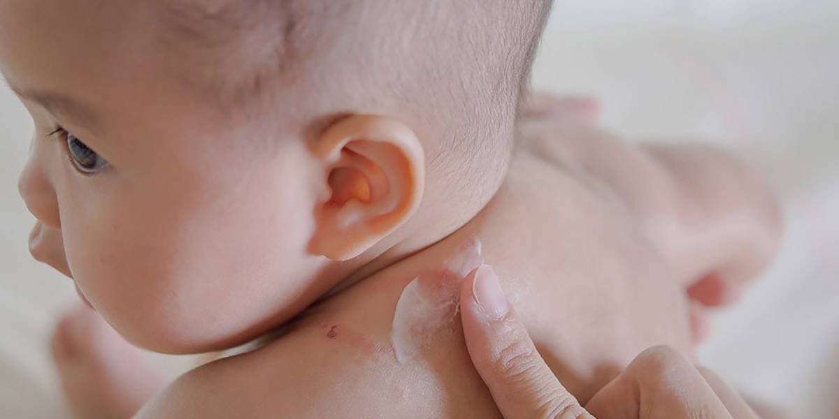 درمان مشکلات پوستی شایع در کودکان